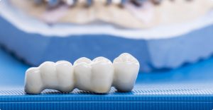 myDentalcare offers high quality dental bridges and crowns for patients that require them.