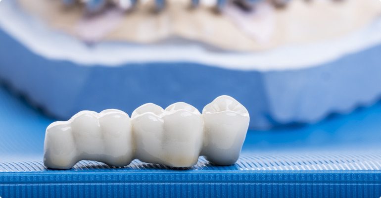 myDentalcare offers high quality dental bridges and crowns for patients that require them.