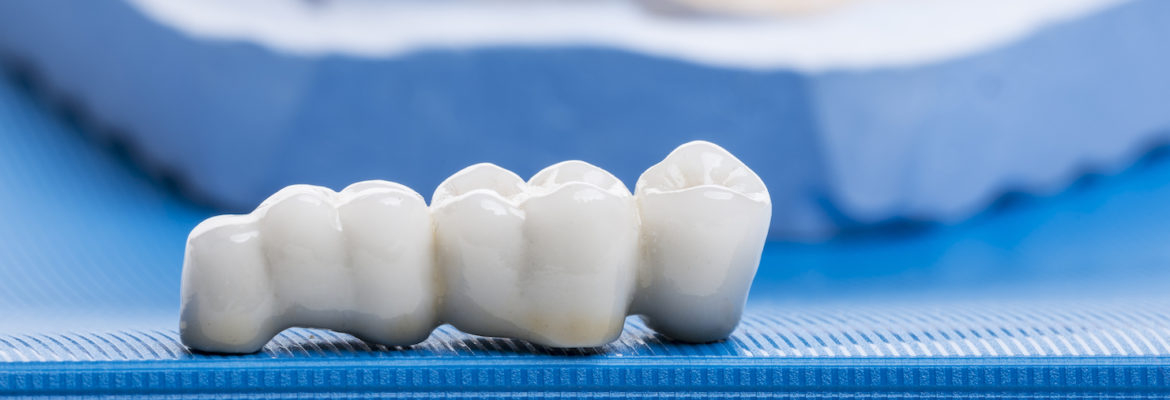 What is better for you a dental crown or bridge | myDentalcare